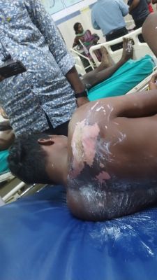 बिजली लाइन के मरम्मत के दौरान दो मजदूर झुलसे....जिला अस्पताल में इलाज जारी